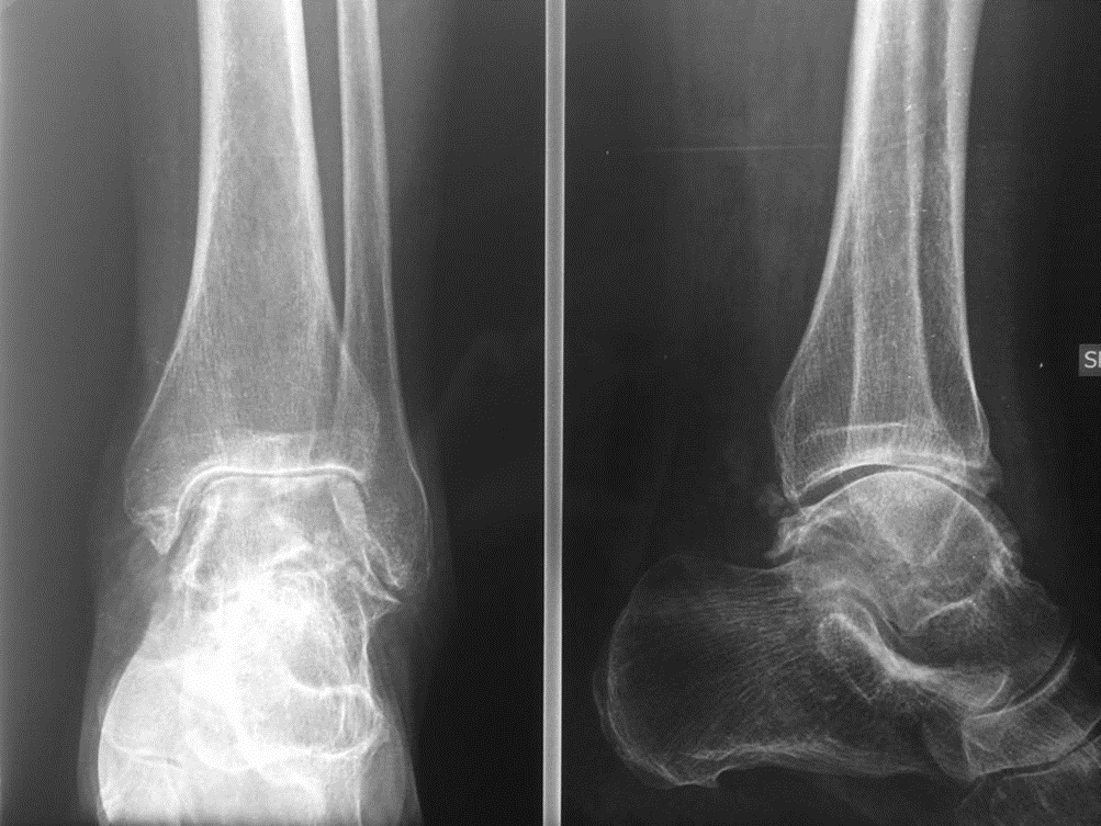 protesi di caviglia e artrosi